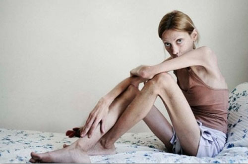 I disturbi alimentari, anoressia e bulimia