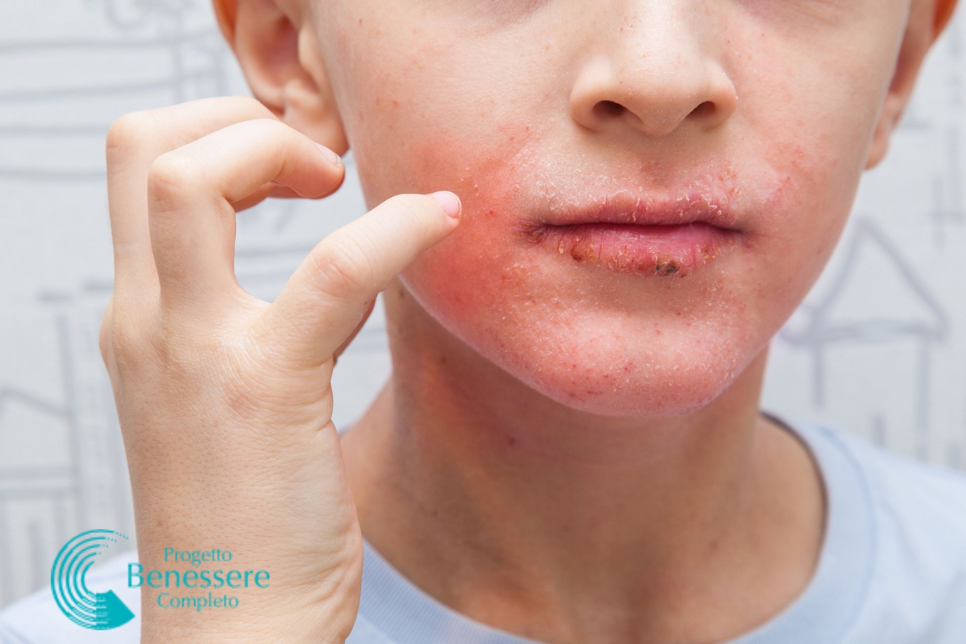 Dermatite, bruciori alla bocca e alla lingua? E se la causa fosse una carenza di vitamina B3?  
