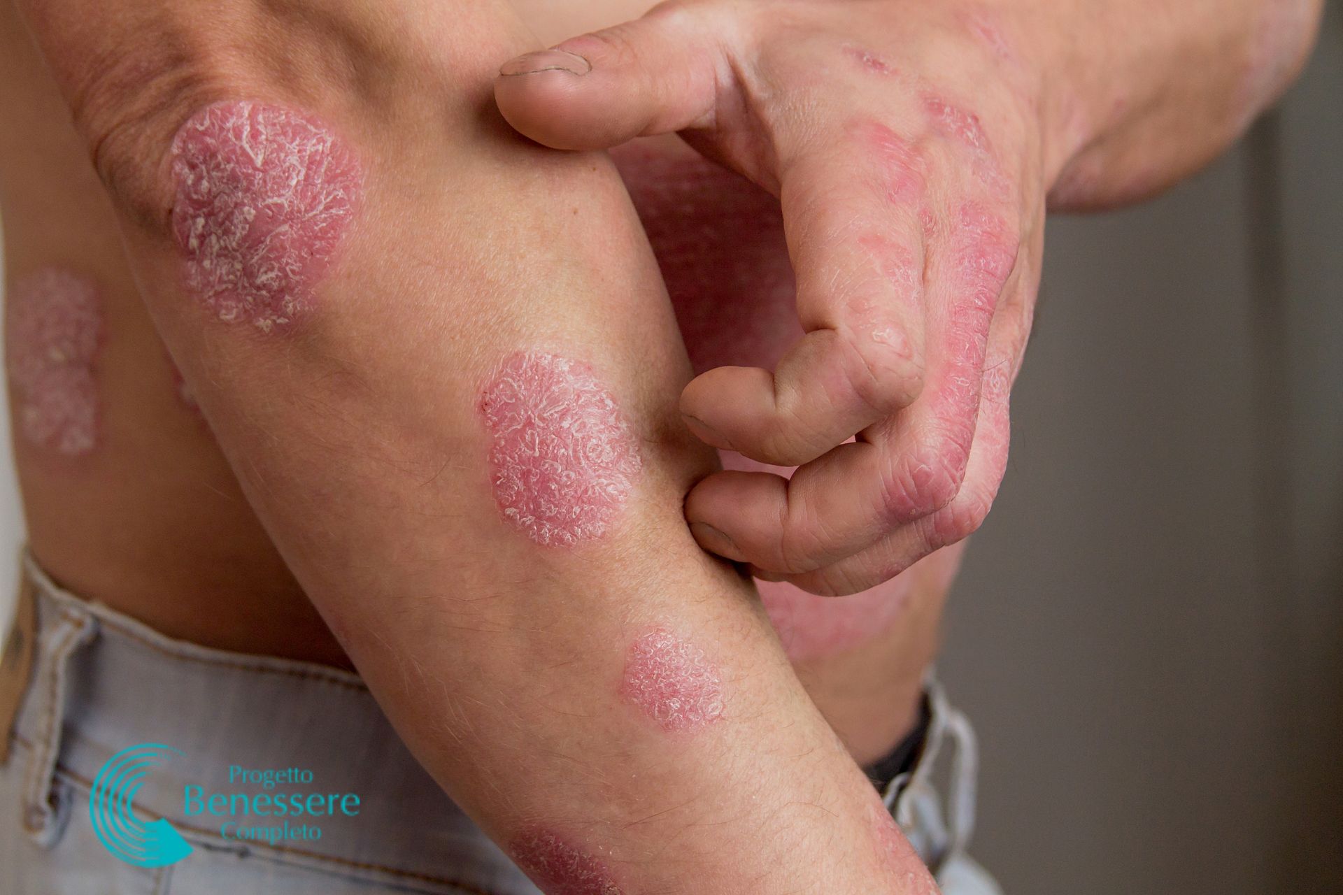 Cosa rappresenta  la psoriasi in psicosomatica? Quali le cure naturali e olistiche più efficaci